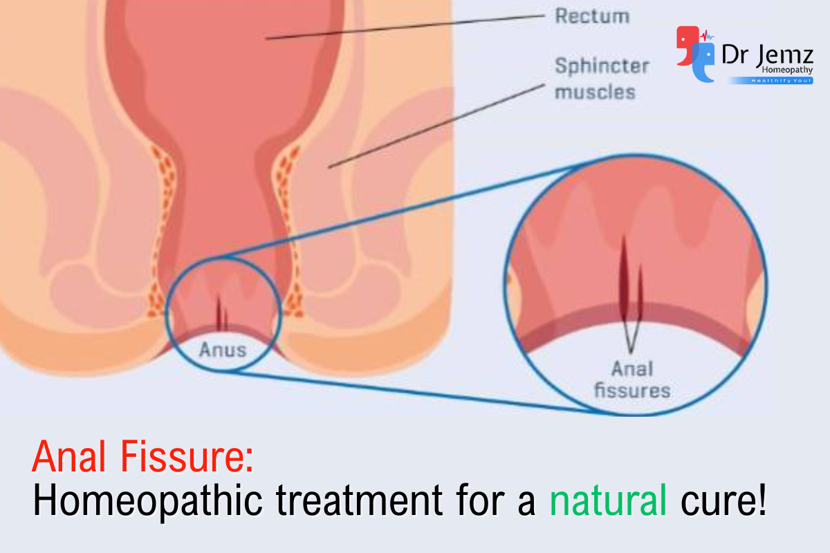 How to Cure Anal fissure Naturally with Homeopathy?