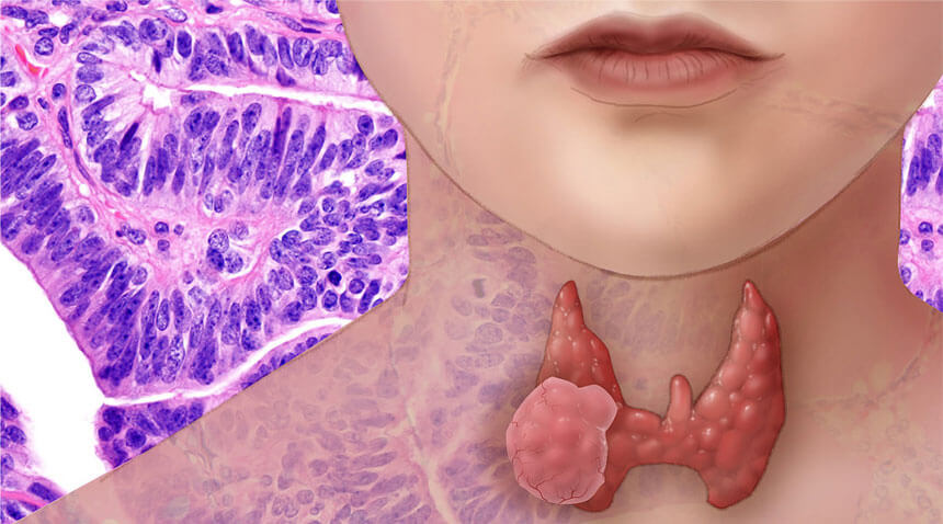 thyroid-problems-dr-jemz-homeopathy
